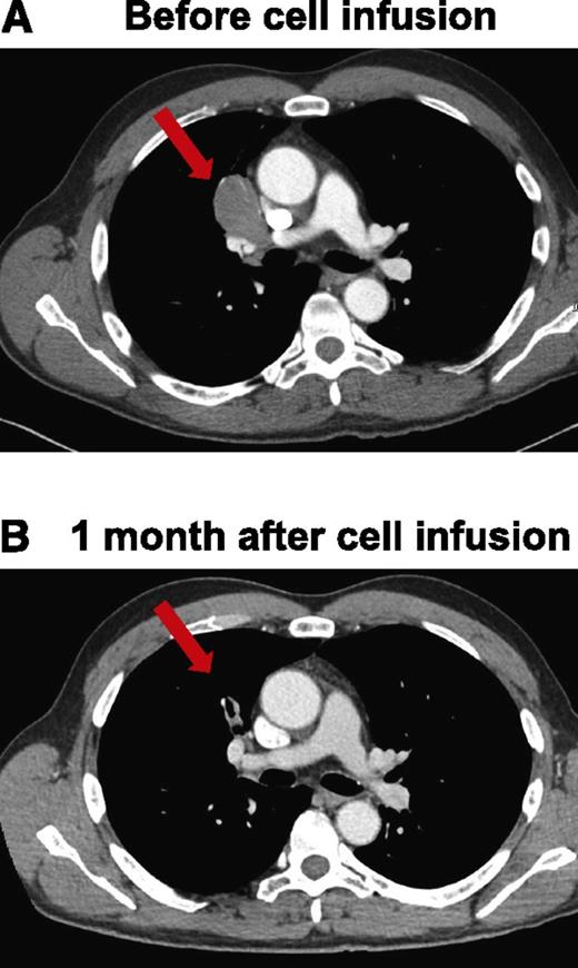 Figure 5. Regression of adenopathy in patient 9 within 1 month after anti-CD19-CAR T-cell infusion. CT scans before the cell infusion (A) and after infusion of anti-CD19-CAR T cells showing that mediastinal adenopathy had regressed in patient 9 (B). The red arrows indicate a lymph node mass that regressed.