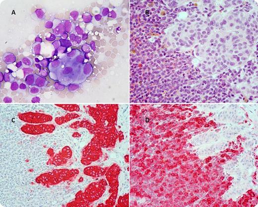 A 66-year-old woman was admitted in January 2009 for severe thrombocytopenia, mild leukocytosis, and anemia (white blood cells 12 × 109/L; hemoglobin, 10 g/dL; platelets, 3 × 109/L). In 2001, she underwent bilateral mastectomy, radiotherapy, and chemotherapy, including alkylating agents and topoisomerase II inhibitors, for invasive ductal breast carcinoma. In 2005, she relapsed with cervical, axillary, and pulmonary involvement and later hepatic disease. Capecitabine was discontinued in December 2008 because of clinical deterioration and severe leuko-thrombocytopenia. At admission, her differential count showed 56% monocytes and 7% agranular blasts. / Bone marrow (BM) aspirate (panel A) and trephine biopsy (panel B) examination documented a high percentage (50% of BM cellularity) of myeloblasts and promonocytes and infiltration by epithelial neoplastic cells. Immunohistochemistry with anti-cytokeratin (panel C) and anti-myeloperoxidase (panel D) antibodies confirmed the cyto-histological findings. MLL-AF9 type A fusion transcript was detected by nested reverse transcriptase-polymerase chain reaction, whereas conventional cytogenetic analysis failed due to the absence of evaluable metaphases. The final diagnosis was therapy-related acute myeloid leukemia (World Health Organization. Classification of tumors of haematopoietic and lymphoid tissues. 4th edition, 2008), with simultaneous breast cancer metastasis. The patient received supportive care and died in May 2009. Although therapy-related myeloid neoplasms are not rare, particularly after treatment of breast cancer, it was surprising to demonstrate hematopoietic and solid organ neoplastic cells in the same BM specimen.