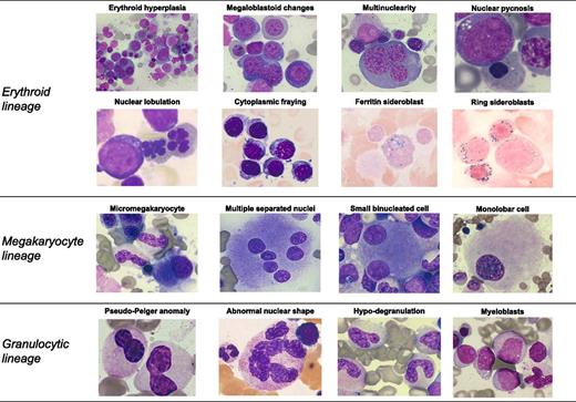 Figure 1. Representative examples of morphologic abnormalities of myelodysplasia. May Grünwald Giemsa staining in all cases with the only exception of ring sideroblasts (Perls staining). Magnification from 200× to 1000×, courtesy of Erica Travaglino.