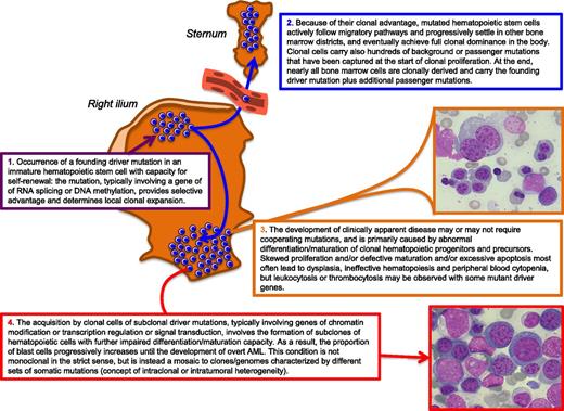 Figure 2. Schematic representation of our current understanding of the pathophysiology of myelodysplasia. In this example, the founding driver mutation is assumed to occur in a hematopoietic cell located in the bone marrow of the right ilium, and the sternum is shown as an anatomically separated bone marrow district to illustrate the concept of mutated stem cell migration through peripheral blood. Bone marrow microphotographs: magnification from 600×, courtesy of Erica Travaglino.