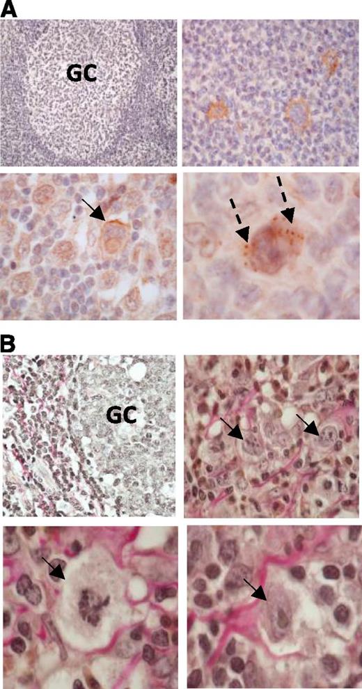 Figure 2. DDR1 overexpressing primary HRS cells intimately associate with collagen. (A) Immunohistochemistry stain for DDR1 expression in Hodgkin lymphoma. DDR1 was either absent or only weakly expressed in normal GC cells of a nonmalignant tonsil (left, upper panel). Original magnification ×200. Remaining panels show representative examples of DDR1 expression in primary HRS cells. DDR1 expression in HRS cells was localized to the cell membrane (arrows) or as focal aggregates in the cytoplasm (broken arrows). Original magnifications: right upper panel ×400; left lower panel ×600 oil immersion lens; right lower panel ×1000 oil immersion lens. (B) van Gieson’s stain of a nonmalignant tonsil shows limited collagen deposition within the GC (left, upper panel; original magnification ×400) and by comparison DDR1-positive HRS cells (arrows) are frequently intimately associated with collagen (red staining). Original magnifications: right upper panel ×600 oil immersion lens; lower panels ×1000 oil immersion lens. GC, germinal center.