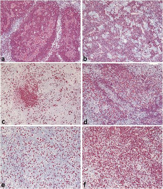 Figure 1. Histopathologic NLPHL variants according to Fan et al. (A) Pattern A: B cell–rich nodular, tumor cell–rich case with high numbers of LP cells in the nodules; (B) pattern B: serpiginous/interconnected; (C) pattern C: an infiltrate with prominent extranodular LP cells; (D) pattern D: a T cell–rich nodular pattern; (E) pattern E: a diffuse T cell/histiocyte–rich B-cell lymphoma–like pattern; and (F) pattern F: a diffuse, moth-eaten pattern. CD20-immunostaining, original magnification ×40.