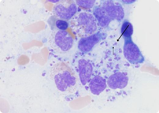 A 39-year-old Honduran man with a history of AIDS (CD4 = 68/mm3) and suspected visceral leishmaniasis (VL) was referred to the hematology clinic for pancytopenia. The patient was diagnosed with cutaneous leishmaniasis on skin biopsy 1.5 years prior, which was determined to be Leishmania donovani chagasi. The patient received an initial liposomal amphotericin B regimen, followed by maintenance monthly dosing, which was ongoing at the time of our visit. On presentation to our clinic, the patient reported fatigue and was found to have splenomegaly on examination. Laboratory work showed a white blood cell count of 1.8 × 109/L (absolute neutrophil count = 0.8 × 109/L), hemoglobin of 6.5 g/dL, and platelet count of 56 × 109/L, all of which had deteriorated despite therapy. A bone marrow aspiration revealed numerous extracellular and intracellular (histiocytes and macrophages) parasites consistent with Leishmania at the amastigote stage of development. To accurately diagnose Leishmania, a nucleus (long arrow) and a kinetoplast (short arrow) must be visualized within each amastigote. The bone marrow aspirate was useful because it confirmed that the Leishmaniasis was visceral, and it provided an explanation for the patient’s pancytopenia. Leishmania amastigotes can also be identified on peripheral smear in patients with severe immunosuppression. / VL/HIV coinfection is a growing worldwide concern due to frequent progression of VL despite what would normally be adequate treatment of both VL and HIV.