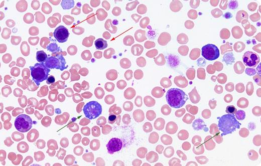 A 69-year-old woman was admitted with rapidly declining hypotension and respiratory failure requiring intubation. She had been diagnosed with polycythemia vera, JAK-2 (V617F) positive, 28 years earlier. After 20 years of stable disease she developed massive splenomegaly and progressed to myelofibrosis. Splenectomy had been performed 7 years earlier for symptomatic relief. Two weeks prior to admission, her hemoglobin was 114 g/L, leukocytes were 9.7 × 109/L, and platelets were 352 × 109/L. At admission, her complete blood count was reported with a leukocyte count of 133 × 109/L, although this was flagged as the impedance volume histogram of the leukocyte population produced by the cell counter had several abnormal peaks. Blood film showed a leukoerythroblastosis with numerous nucleated red blood cells (red arrows) and megakaryocytic fragments (green arrows). These cells were incorrectly identified as leukocytes by the cell counter, and manual examination of the peripheral smear revealed the leukocyte count was actually 41 × 109/L, although markedly left-shifted. The patient unfortunately died of cardiogenic shock and sepsis after care was withdrawn. / The blood film in this case confirmed an error in our automated cell counter and provided a window into her disease and perhaps into the stress placed onto her marrow.