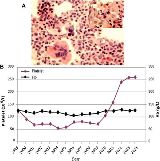 Figure 1. (A) Bone marrow biopsy showed normal cellularity, trilineage hematopoiesis, and all stages of maturation. Megakaryocytes are moderately increased in number, and some appeared with nuclear hyperlobulation; the inset shows a small cluster of characteristic Gaucher cells. (B) Changes in platelet count and hemoglobin level during the course of Gaucher disease.