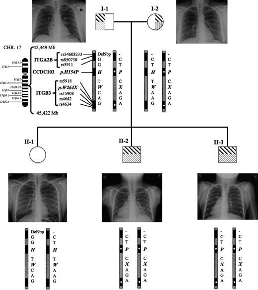 Figure 1. The genealogical chart of an Italian family with coinheritance of GT and PCD. Chest radiology images are shown. Below is an ideogram of the chromosome 17 and the 3Mb segment containing the ITGA2B, ITGB3, and CCDC103 genes (filled boxes). Genotypes of common and causative mutations (bold) are indicated, and the inherited causative haplotype is reported (asterisks).