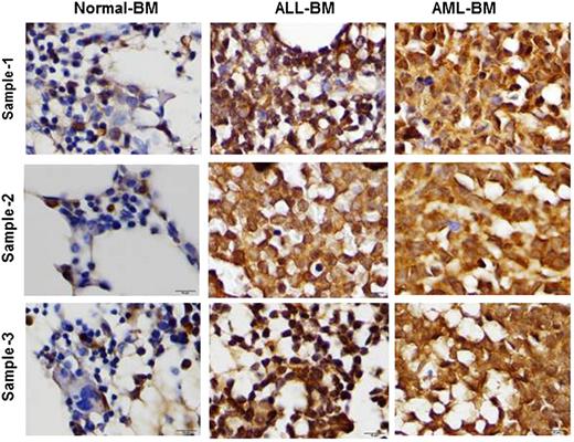 Figure 6. Leptin is highly expressed in AML and ALL BM. To analyze leptin expression on leukemia BM, paraffin-embedded BM biopsy specimens were formalin fixed and formic acid decalcified. Leptin expression was assessed using a rabbit anti-human leptin polyclonal antibody (Cone Ab16227) by immunohistochemistry.