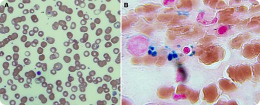 A 52-year-old African-American woman with a history of allergic rhinitis and alcohol abuse presented with a presyncope. The following levels were found: hemoglobin, 3.7 g/dL; mean cell volume, 82 fL; white blood cell count, 9.2 × 103/μL; and platelets, 168 × 103/μL. The workup was negative for hemolysis or bleeding. Her blood alcohol level was normal. B12 and folate levels were normal. A peripheral smear showed dimorphic red blood cells with Pappenheimer bodies (panel A). A bone marrow biopsy showed slightly hypercellular marrow with intact trilineage hematopoiesis and mild erythroid dyspoiesis. An iron stain showed adequate iron content and occasional ring sideroblasts (panel B). Marrow morphology and cytogenetic analysis did not support a myelodysplastic syndrome. Copper and ceruloplasmin levels were low at 515 μg/L and 16 mg/dL (normal ranges, 810-1990 μg/L and 20-60 mg/dL), respectively. The zinc level was elevated at 186 μg/dL (normal range, 60-130 μg/dL). The patient admitted to self-treating her chronic cough with zinc lozenges for the last 4 months. / Our impression was that sideroblastic anemia caused by copper deficiency induced by zinc lozenge use was a significant component of the severe anemia. Zinc lozenges were discontinued, and copper supplements were initiated, with complete hematologic recovery in 4 weeks.