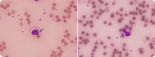 A 66-year-old diabetic man presented with breathlessness, vomiting, and fever. His initial blood count demonstrated hemoglobin 135 g/L (130-175), platelets 155 × 109/L (150-400), and white blood cells 18.3 × 109/L (4-11). His hemoglobin fell rapidly over 6 hours to 44 g/L, platelets fell to 39 × 109/L, and white blood cells increased to 20.4 × 109/L. d-Dimer assay was 35 857 ng/mL (<250), fibrinogen was 0.3 g/L (1.5-4), and international normalized ratio was 3.6, supporting a diagnosis of disseminated intravascular coagulopathy. The blood serum turned black secondary to hemolysis. The peripheral blood film showed microspherocytes with erythrophagocytosis and thrombocytopaenia. Neutrophils showed left shift and vacuolation. Two band forms were identified with an intracytoplasmic bacillus. Despite intensive care support and intravenous antibiotics, the patient arrested and was pronounced dead 6 hours following admission. Subsequently, blood samples cultured a Clostridium perfringens isolate. / C. perfringens commonly secretes an α toxin that has phospholipase activity. This can induce massive hemolysis by disrupting cell membrane integrity through the hydrolysis of sphingomyelin and lecithin. Massive intravascular hemolysis is a rare but well-documented complication and is often rapidly fatal. Risk factors include diabetes and underlying hematologic disorders.