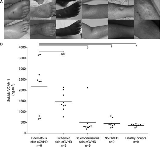 Figure 1. Clinical pictures and sVCAM-1 plasma levels in patients with edematous skin cGVHD. (A) Clinical pictures of 6 patients: (upper) inflammatory pitting edema and (lower) sclerodermatous evolution during follow-up. (B) Increased plasma sVCAM-1 levels in patients with edematous and lichenoid cGVHD. Scatter plots show plasma sVCAM-1 concentrations as measured by enzyme-linked immunosorbent assay in 9 patients with edematous skin cGVHD, 9 patients with lichenoid skin cGVHD, 9 patients with sclerodermatous skin cGVHD, 9 patients with hematopoietic stem cell transplantation but no cGVHD, and 9 healthy donors. Each dot represents an individual subject, and horizontal bars represent group means. Significant differences between group means are indicated: *P < .01 (Mann-Whitney nonparametric test).