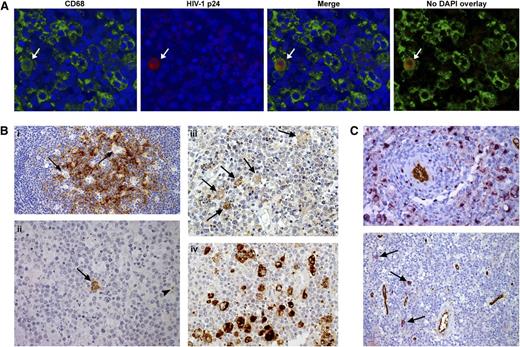 Figure 3. Identification of HIV-1 in a positive specimen. (A) Double immunofluorescence using fluorescein isothiocyanate-conjugated antibody to CD68 in association with HIV-1 p24 (labeled with Texas Red). HIV-1–producing macrophages showing characteristic mixed (orange) fluorescence (white arrow) account for a small percentage of the total CD68+ cell population (<0.5%). Slides were scanned and analyzed with an Olympus BX61 fluorescent microscope. (B) Control tissue (persistent generalized lymphadenopathy) stained with p24 immunoperoxidase (i). The bulk of p24 is associated with follicular dendritic cell processes whereas the tingible-body macrophages (arrows) are negative (original magnification, ×100). In AR-DLBCL tissue (ii), few cells react with p24. The arrow indicates an infected macrophage and the arrowhead points to a lymphocyte (original magnification, ×400). Staining of the same AR-DLBCL biopsy for the HIV-1 regulatory tat protein (iii) revealed a higher number of infected macrophages (original magnification, ×400). (iv) The total macrophage population in this case is highlighted by the marker CD68. (C) Double staining using VIP (purple) for CD68 and DAB (brown) for CD34 (top) showing a ring of perivascular macrophages (original magnification, ×400). On double staining, p24 purple and CD34 brown (bottom), HIV-1–expressing macrophages (arrows) are not specifically seen perivascularly (original magnification, ×200). Images were obtained with a Leica DM2500 microscope.