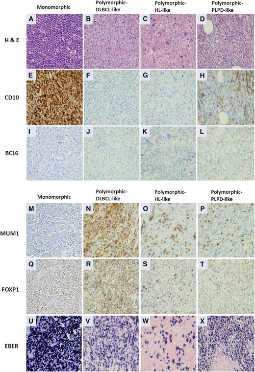 Figure 4. Morphologic variants and immunophenotypic profiling in EBV-positive diffuse large B-cell lymphomas of the elderly. (A,E,I,M,Q,U) The monomorphic subtype is characterized by monotonous sheets of large transformed B cells. (B,F,J,N,R,V) Polymorphic DLBCL-like subtype shows canonical large B-cell neoplasm morphology, characterized by a high density of large neoplastic cells and scattered cells with Reed-Sternberg (RS)-like and Hodgkin-like features. (C,G,K,O,S,W) The polymorphic HL-like subtype shows a lower density of neoplastic cells with RS-like and Hodgkin-like features. (D,H,L,P,T,X) The polymorphic PLPD-like subtype is DLBCL with polymorphic LPD-like features. It is characterized by a low density of neoplastic cells without HL-like features. EBV-positive DLBCL of the elderly is predominantly the ABC subtype. (A,E,I,M,Q,U) Interestingly, the monomorphic case presented in this figure shows the GCB subtype. All polymorphic subtypes show the ABC-DLBCL molecular phenotype.
