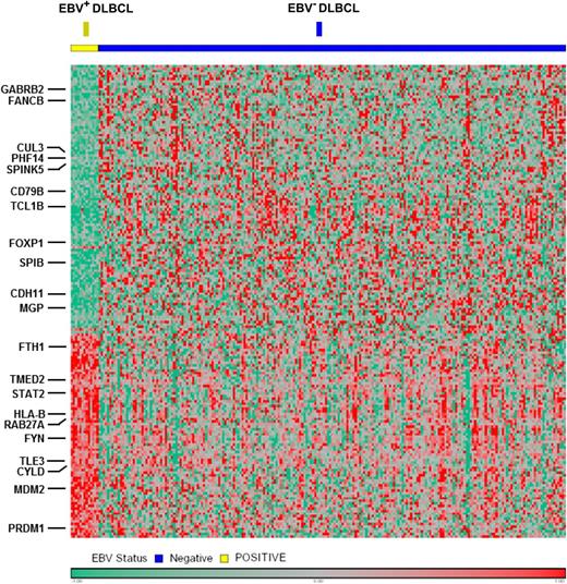 Figure 5. Gene expression profiling in the DLBCL ABC subtype was performed according to EBV status. The EBV-positive case shows a distinct gene expression pattern compared with cases with EBV negativity, with overexpression of multiple components of the NF-κB pathway.