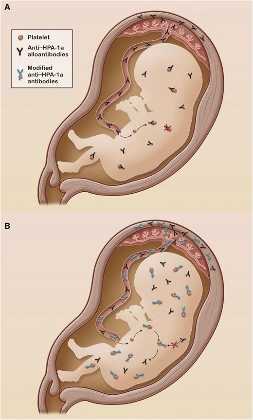 (A) Fetal thrombocytopenia due to maternal anti–HPA-1a alloantibodies. (B) Fetal platelets protected from alloantibody-mediated destruction by modified anti–HPA-1a antibodies that bind to fetal platelets but do not cause phagocytosis. Professional illustration by Alice Y. Chen.