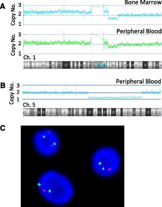 Figure 1. SNP array copy number ideograms of chromosome 1 (USN1902) and chromosome 5 (USN9124). (A) Comparison of chromosomal abnormalities present in BM and PB. Copy number variations present in the BM are clearly visible in PB; however, they are slightly reduced (BM gain CN-2.3, loss CN-1.7; PB gain CN-2.1, loss CN-1.85). (B) Representative ideogram of chromosome 5 from a patient with 5q syndrome showing del(5q). (C) FISH analysis showing 2 cells with del5q and 1 with a normal chromosome 5 from the PB of a 5q-syndrome patient. The red and the green probes are the 5q31 EGR1 and the 5p15 D15523/D55721 probes, respectively.