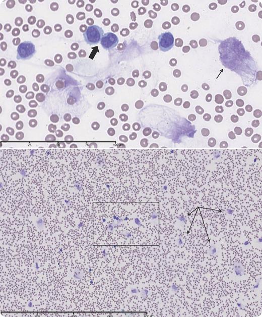 An 80-year-old white male diagnosed with de novo B-cell prolymphocytic leukemia (B-PLL) presented with increasing fatigue and moderate splenomegaly without palpable lymphadenopathy following treatment with chlorambucil. A chest CT scan showed pulmonary infiltrates, presumed to be leukemic, with a nondiagnostic bronchoalveolar lavage. The white blood cell (WBC) count was 72 × 109/L, with 82% prolymphocytes. Immunophenotyping showed that 86% of leukocytes expressed CD19, CD20, CD22, and high-density κ immunoglobulin light chain. A bone marrow biopsy showed marked infiltration by lymphocytes of variable sizes, with prominent nucleoli and lacking expression of CD5 or CD10. The peripheral blood smear showed atypical, large lymphocytes with condensed chromatin, prominent nucleoli, and abundant cytoplasm with smooth contours (bold arrow). The patient was treated with weekly pentostatin, which reduced the WBC count to 19 × 109/L. A repeat blood smear revealed numerous smudge cells (thin arrows) admixed with typical prolymphocytes. / B-PLL is a rare B-cell malignancy with a poor prognosis, distinguished from chronic lymphocytic leukemia (CLL), hairy cell leukemia, and secondary PLL arising from CLL. A diagnosis of de novo PLL requires an initial percentage of prolymphocytes >55%. This case demonstrated the tendency of circulating prolymphocytic leukemia cells to rupture during the preparation of the blood smear.