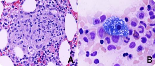 A 77-year-old man was admitted for evaluation of pancytopenia. His blood examination revealed hemoglobin 9.7 g/dL, platelet count 149 × 109/L, and white blood cell count 3.2 × 109/L with normal differential. Peripheral blood smear showed red blood cells with anisocytosis, microcytes, and teardrop-shaped cells. There was mild leukopenia with relative monocytosis and normal platelets. Bone marrow biopsy showed 30% to 40% cellularity with absent iron stores and multiple granulomas with macrophages (panel A). No foreign bodies or caseous necrosis were noted. Most remarkably there were several macrophages with sea-blue–colored granules (panel B). Stains for fungus and acid-fast bacillus were negative. Cytogenetics did not reveal any abnormalities. / Sea-blue–colored histiocytes have been described in the setting of high rates of intramedullary cell death due to lipid storage diseases, myelodysplastic syndromes, lymphomas, chronic myelogenous leukemia, idiopathic thrombocytopenic purpura, autoimmune neutropenia, and β-thalassemia major. We hypothesize that the bone marrow granulomas led to increased cell death and subsequent deposition of phospholipids in the macrophages, resulting in the formation of the sea-blue–colored histiocytes.