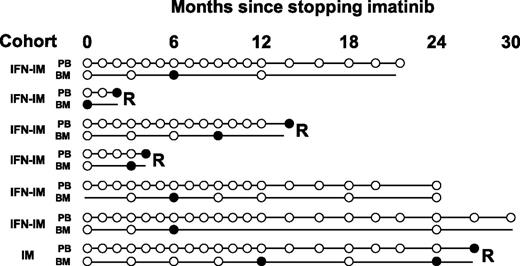 Figure 3. BM qRT-PCR is not clinically useful as a predictor of molecular relapse. Seven patients had detectable BCR-ABL mRNA in BM on at least one occasion while PB monitoring indicated stable UMRD. Samples with no detectable BCR-ABL are shown as open circles, and positive samples are shown as solid circles. Molecular relapse is denoted by “R” at the end of the timeline. The BM qRT-PCR indicated imminent molecular relapse in only 2 patients.