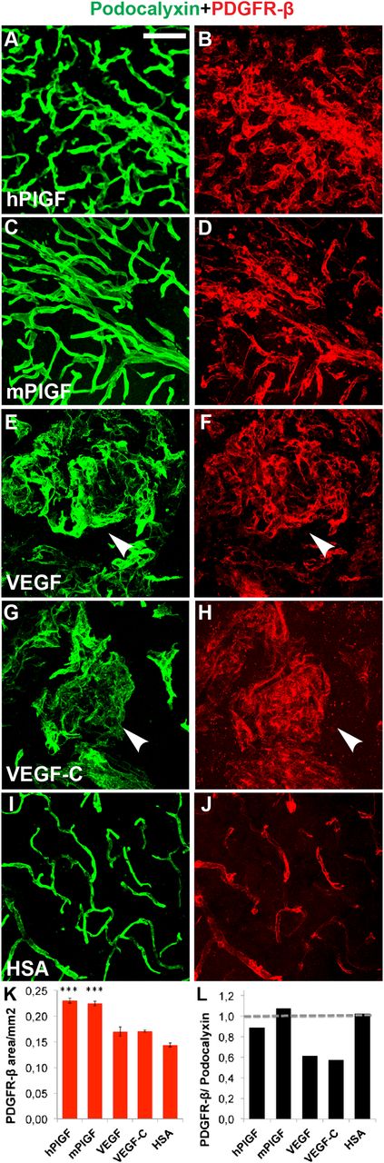 Figure 3. Immunohistochemical evidence for mural cell recruitment after PlGF treatment. Immunostaining of endothelial cells for (A,C,E,G,I,) podocalyxin (green) and for (B,D,F,H,J) pericytes (PDGFR-β, red). (K-L) Quantitative analysis of (K) PDGFR-β–positive area, and quantitative comparison of (L) podocalyxin vs PDGFR-β–positive areas, with horizontal line at 1, referring to equal area with both stainings. (E-H) Arrowheads point to hemangiomas. ***P < .001 when compared with HSA control; error bars show SD. Scale bar, 50 μm.