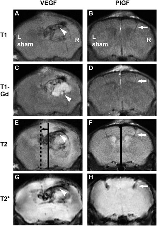 Figure 7. In vivo effects of VEGF and PlGF visualized by MRI. Right-sided growth factor injections were performed accompanied by left-sided sham operation. Incubation time: 2 weeks. (A) After VEGF gene transfer, the macroanatomy of the brain is distorted as observed in T1 images, (C) the BBB is disintegrated from a large area seen as enhancement (white) on T1-Gd series, (E, continuous line: anatomical midline, dashed line: actual midline, black arrow: brain shift) T2 sequence shows major edema (white) with brain shift, and T2* demonstrates hemorrhage (black). Arrowheads point to a hemangioma. Note that after PlGF treatment, (B) the macroanatomy is intact, (D) enhancement is minimal, (F, continuous line: anatomical and actual midline coincide) there is no edema and no brain shift, and (H) minor hemorrhage is only seen at injection path. White arrows point to injection path.