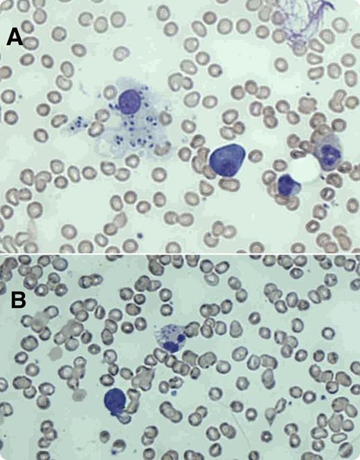 A 67-year-old white British man presented with a 2-month history of headache, fever, night sweats, and weight loss. Physical examination revealed splenomegaly. Laboratory tests showed a hemoglobin level of 111 g/L, white cell count of 1.5 × 109/L, neutrophil count of 0.4 × 109/L, and platelet count of 129 × 109/L. The man was HIV negative, and a blood film was nondiagnostic. Bone marrow aspirate showed (panel A) macrophages with intracellular forms of Leishmania amastigotes and (panel B) amastigote forms within a neutrophil. A culture of bone marrow in modified Novy-MacNeal-Nicolle media grew Leishmania promastigotes. Polymerase chain reaction with primers to amplify kinetoplast DNA minicircles on bone marrow was positive for Leishmania donovani. When asked retrospectively, he noted that he had delivered yachts in the Mediterranean over the last 5 years. His last trip to Portugal was 6 months before presentation. He had never traveled to the Indian subcontinent or central or east Africa where visceral leishmaniasis is endemic. The patient was treated with liposomal amphotericin B at a dose of 3 mg/kg/day from days 1 to 5 and day 10. His blood counts normalized, and his symptoms improved with regression of splenomegaly. / Visceral leishmaniasis has infrequently been reported from southern Europe, northern Africa, and the Mediterranean according to the World Health Organization and should be considered in travelers regardless of ethnicity.