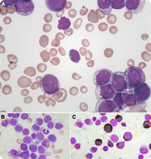 The complete blood count of a 40-year-old man showed a hemoglobin level of 6 g/dL, an erythrocyte count of 3.0 × 1012/L, a leukocyte count of 62 × 109/L with 90% blasts, and a platelet count of 12 × 109/L. The bone marrow smears were hypercellular, with a preponderance of blasts (90%) with dispersed nuclear chromatin and multiple prominent nucleoli and a variable amount of cytoplasm. Its granularity (panel A) had the occasional presence of an eosinophil precursor (panel B). Some blasts showed myeloperoxidase positivity (panel C). On flow cytometry, the CD45/side-scatter gated cell cluster revealed an immunophenotype of CD13, CD33, CD14, CD11b, CD11c, and CD64. A multiplex reverse transcription-polymerase chain reaction confirmed the case as acute myeloid leukemia with t(16;16)(p13.1;q22); CBFB-MYH11. However, in view of the presence of a few microcytes and target cells (panels A-B), high-performance liquid chromatography was performed, and a coexisting hemoglobin E disease was confirmed. / The striking features of a dominating disease often cast shadows on another coexisting disease, leading to underdiagnosis of the latter. A practice of searching for ambiguities beyond the obviousness provides us a more complete diagnosis. In this case of acute myeloid leukemia, the coexistence of hemoglobin E disease may not have a significant impact on the treatment protocol, but a complete diagnosis always contributes to a more personalized therapy.