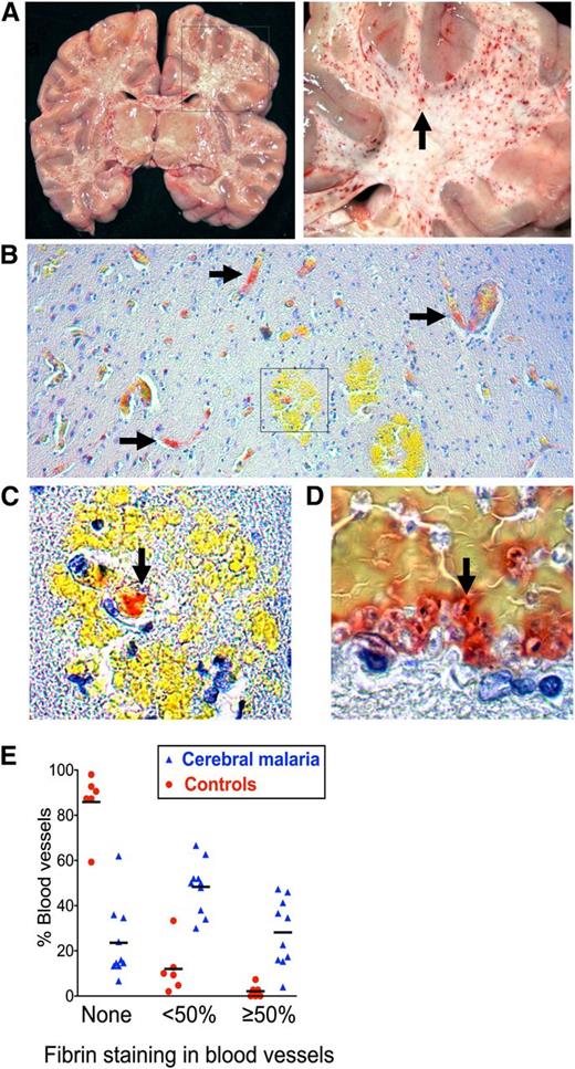 Figure 1. Microvascular thrombosis in association with IE sequestration in CM. (A) Coronal section of the brain from a child with fatal CM (right image detail of box in left) shows typical hemorrhagic lesions (arrow). (B) Low-power view (10× lens) shows fibrin deposition in microvessels in formalin-fixed paraffin-embedded tissue from CM case stained for fibrin using trichromic staining (fibrin stains red and red blood cells stain yellow) (C) Detail of box in 1B (40× lens) shows fibrin at the center of a ring hemorrhage (arrow). (D) Colocalization of fibrin and IE cells as indicated by malaria pigment (black dots, arrow). (E) Fibrin deposition was significantly higher in CM cases than in non-CM encephalopathic illness controls. The extent of the vessel lumen containing fibrin was scored as none, <50%, or ≥50 in 10 CM cases and 6 non-CM controls. Scoring was performed by the author and 2 blinded medical pathologists who each scored 50 vessels per case. Datapoints are a combination of the data from all 3 scorers and indicate the percentage of vessels scored at each level in individual cases and bars the mean percentage of vessels scored at each level for the CM or non-CM group as a whole. Micrographs were taken using a Leica DM1L microscope (Leica Microsystems) and a Micropublisher 3.3 RTV (QImaging) camera using Image ProPlus version 6.2 software (Media Cybernetics).