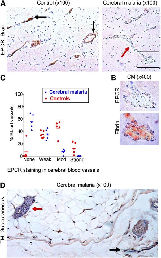 Figure 2. Loss of EPCR in the brain in CM and of TM in subcutaneous tissue. (A) Low-power (10× lens) view of postmortem brain samples shows vessels with moderate-to-strong staining for EPCR (immunoperoxidase method, arrows) in a non-CM control brain sample (left) and absence of EPCR staining in a vessel containing many sequestered IEs (arrow) in a CM case (right). (B) Association between IE sequestration, loss of EPCR, and fibrin deposition; upper image is a detail (40× lens) of the box in the bottom right of 2A and the lower image shows fibrin deposition (trichromic staining) in a consecutive tissue section. (C) EPCR staining is significantly reduced in CM compared with non-CM encephalopathic controls. The intensity of staining for EPCR was scored as none, weak, moderate (mod), or strong in 5 CM cases and 5 controls compared with reference images by the author and 2 independent pathologists. Datapoints are a combination of the data from all 3 scorers and indicate the percentage of vessels scored at each level in individual cases and bars the mean percentage of vessels scored at each level for the CM or non-CM group as a whole. (D) Subcutaneous tissue section in a fatal CM case. The red arrow indicates a vessel with high IE sequestration and minimal TM staining and the black arrow indicates a vessel with minimal IE sequestration and strong TM staining.