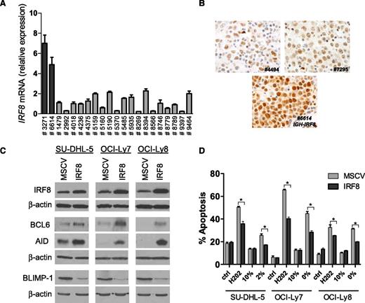Figure 2. IRF8 role in lymphomagenesis. (A) Real-time RT-PCR–based measurement of IRF8 expression in 21 nodal DLBCLs studied with the capture/sequence methodology demonstrates higher levels in the 2 tumors with the IGH-IRF8 fusion (ID #3271 and #6614). (B) Immunohistochemistry examination confirms the overexpression of IRF8 in a biopsy with an IGH-IRF8 fusion (#6614) compared with 2 DLBCLs lacking this rearrangement (600×). (C) Ectopic expression of IRF8 in 3 DLBCL cell lines led to the emergence of a lymphomagenic profile characterized by heightened expression of BCL6 and AID and suppression of PRMD1. (D) DLBCL cells ectopically expressing IRF8 became significantly resistant to apoptosis induced by H202 and serum deprivation (*P < .01, Student t test); ctrl (control) and 10% indicate the basal apoptosis rate in cells exposed to vehicle or grown in media supplemented with 10% fetal bovine serum, respectively. Bars labeled 2% or 0% correspond to cells grown in serum-deprived conditions. All data points were collected in triplicate at 24 hours, and the results were confirmed in 3 independent biological replicates; the results displayed represent the mean and standard deviation of a biological replicate.