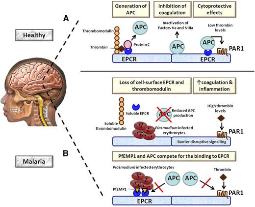 Role of EPCR in cerebral malaria. (A) During normal homeostasis, excessive thrombin is bound by thrombomodulin expressed by endothelial cells. The thrombomodulin-thrombin complex activates protein C to APC, a process that is strongly accelerated by EPCR. APC exerts anticoagulant effects when it becomes detached from EPCR by inactivating clotting factor Va and VIIIa. In addition, APC bound to EPCR has cytoprotective properties by activating PAR1. (B) (Upper) In malaria, parasite-infected erythrocytes induce the loss of EPCR and thrombomodulin from the endothelial cell surface at least in part by shedding of these receptors. As a consequence, the capacity to produce APC is greatly impaired, resulting in enhanced coagulation. The resulting high thrombin levels can induce proinflammatory barrier disruptive effects on blood vessels via PAR1. (Lower) Plasmodium-infected erythrocytes transport PfEMP1 to their membrane, which can bind EPCR in the same region as APC. As a result, APC is less capable of inducing cytoprotective effects via PAR1.
