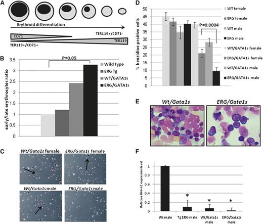 Figure 5. Erythroid differentiation arrest in ERG/GATA1s mice. (A) Schematic representation of erythroid differentiation indicating early erythrocytes as Ter119+/CD71+ and late differentiated erythrocytes as Ter119+/CD71−. (B) Increase in early erythroblast population compared with late differentiated erythrocytes in ERG/Gata1s males. FL cells were isolated from E14.5 Wild-type, TgERG, Wt/Gata1s, and ERG/Gata1s male embryos and stained with Ter119 and CD71. Statistical significance between Wt embryos and the remaining genotypes was measured using the t test. (C-D) Reduced benzidine-stained cells in ERG/Gata1s males. Representative images of benzidine-stained FL cells (C) and a graph averaging the ratio of benzidine-positive cells in FLs isolated from E14.5 Wt, TgERG, Wt/Gata1s, and ERG/Gata1s male and female embryos (D). The bar graph represents the average of at least 3 experiments. (E) Giemsa stain of cytospins of E14.5 FL cells show a decrease in maturing erythroblasts and increase in immature proerythroblasts in ERG/Gata1s males compared with Wt/Gata1s males. (F) Expression of hemoglobin. Adult hemoglobin β major chain (Hbb-b1) expression was measured by real-time PCR in E14.5 FL cells from Wt, TgERG, Wt/Gata1s, and ERG/Gata1s males. *Significant difference from Wt hemoglobin expression was measured using the t test (P = .00037 for TgERG; P < .000001 for Wt/Gata1s; and P < .00001 for ERG/Gata1s).