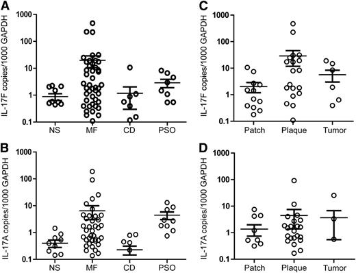 Figure 3. Quantification of IL-17F and IL-17A mRNA in MF and benign skin biopsies. Skin biopsies were obtained from individuals with MF, chronic dermatitis (CD), psoriasis (PSO), and volunteers with normal healthy skin (NS) and used for RNA extraction as described in the methods section. QPCR was performed using primers specific to IL-17F, IL-17A, and GAPDH mRNA. The expression of IL-17F and IL-17A was normalized to GAPDH so that the levels shown represent copies of IL-17F or IL-17A mRNA per 1000 copies of GAPDH mRNA. Depicted is the normalized expression of (A) IL-17F and (B) IL-17A mRNA in NS, MF, CD, and PSO as well as the normalized expression of (C) IL-17F and (D) IL-17A in different types of MF skin lesions. Bars denote the average and standard deviation.
