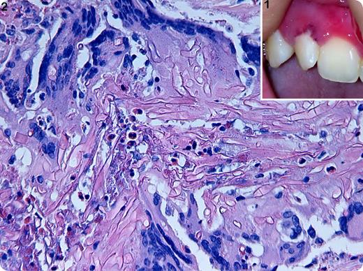 An 18-y-old woman diagnosed of lymphoblastic T-cell lymphoma underwent a second allogenic stem cell transplantation (CD3/CD19 depleted Haploidentical) for relapsing lymphoma. She achieved a third complete remission. Five months later she was admitted for a neutropenic fever. A urinary infection was diagnosed and resolved with broad-spectrum antibiotic. Bone marrow aspiration showed isolated myeloid aplasia. After 4 wk of persistent neutropenia (<100 neutrophils/µL), the fever reappeared. A small ulcerative lesion was observed in the upper maxillary zone (Panel 1). A paranasal sinuses and facial computer tomography was performed. It showed normal features. Zygomicetes spp was isolated in an exudate culture in the lesion itself. A diagnosis of mucormycosis was assumed. The patient underwent a partial maxillectomy and a double antifungal treatment together with posaconazol and liposomal amphotericin. The final histopathological diagnosis was proven by a surgical specimen. Histological findings showed large amounts of necrotic tissue and fungal aseptate and branched Periodic acid-Schiff–positive hyphae, compatible with the diagnosis of invasive mucormycosis (Panel 2). / Successful management of this potentially lethal infection requires early recognition of disease, especially in immunocompromised patients. Highly aggressive surgical approaches and selective medical treatment are paramount to avoid high morbidity and mortality related to this disease.