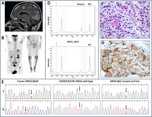 Figure 1. Findings in a 66-year-old man with ECD. (A) Contrast-enhanced sagittal magnetic resonance imaging scan demonstrates lobulated enhancing masses arising from the cerebral meninges. (B) Fluorodeoxyglucose-avid lesions in the abdomen, pelvis, and long bones are shown, and (C) the classic scintigraphic uptake in the long bones is demonstrated. NRAS_182A>G (Q61R) mutation detection assay by MassARRAY (Sequenom) genotyping is demonstrated in (D). This method is designed to generate a small amplicon at a known mutation site from small amounts of tumor FFPE DNA. Mutation calls are based on the mass differences between the wild-type extension product and the mutant extension products as resolved by matrix-assisted laser desorption/ionization time-of-flight mass spectrometry. The single nucleotide change in the extension product is detected by mass spectroscopy. The allele from the tumor (top panel) contains a mutated G allele at position 182. A control wild-type allele is shown (bottom panel). (E) Sanger sequencing of tumor tissue demonstrates the NRAS Q61R mutation in the tumor (left), NRAS wild type in the peripheral blood lymphocytes (middle), and NRAS Q61 mutant melanoma cell line (right) as a positive control. (F) Biopsy result of the presacral mass demonstrates a xanthomatous histiocytic infiltrate, consistent with ECD. (G) Immunohistochemistry result for phosphoextracellular signal-regulated kinase (pERK1/2) is positive in the nuclei of tumor histiocytes (blue arrow) and in the surrounding vasculature but is negative in the nontumor stromal cells (red arrow).