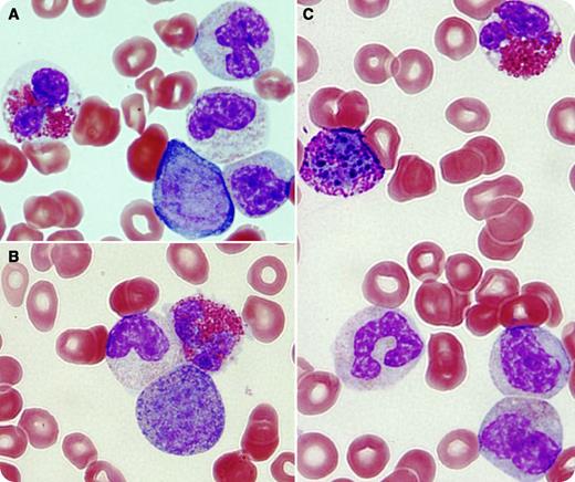 A 35-year-old male presented with a several-weeks history of abdominal discomfort, early satiety, low-grade fever, night sweats, and weight loss. Physical examination revealed pale skin and a massive hepatosplenomegaly. A complete blood count showed severe anemia, thrombocytopenia, and marked leukocytosis (100 000/μL) with 10% blasts, eosinophilia (4000/μL), and basophilia (3000/μL). Peripheral smear demonstrated blasts (panel A), early myeloid precursors (panels A-C), eosinophilia (panels A-C), and basophilia (panel C). Bone marrow biopsy showed myeloid lineage hyperplasia. Cytogenetic analysis was significant for t(8;9)(p22;p24). Testing for JAK2 mutation was negative, and FISH analysis failed to show BCR-ABL1 or any abnormality involving PDGFRA, PDGFRB, or FGFR1 genes. The patient was diagnosed with myeloproliferative neoplasm (MPN)-unclassified after excluding other hematologic neoplasms and causes of eosinophilia/basophilia. / Translocation t(8;9)(p22;p24) has been described to activate JAK2, resulting in a variety of diseases that surpass MPN to include cases of acute leukemia, lymphoma, and myelofibrosis. At the molecular level, t(8;9)(p22;p24) results in a new fusion gene product, putting the pericentriolar material 1 (PCM1) gene located on 8p22 in close proximity with the JAK-2 gene located on 9p24. This results in the continuous activation of JAK2 tyrosine kinase. PCM1-JAK2–positive MPN is a rare disease characterized by an aggressive course and resistance to therapy.