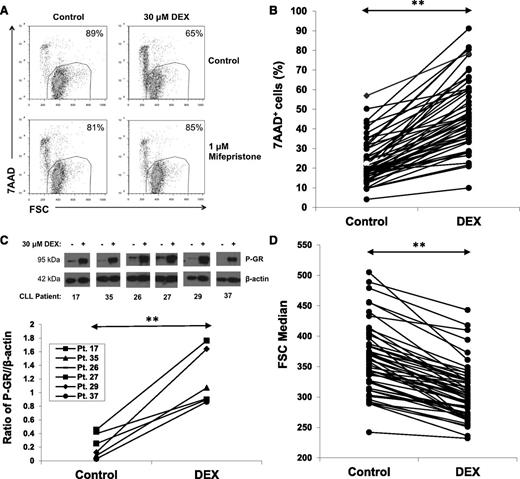 Figure 1. Effect of DEX on circulating CLL cells. (A) CLL cells were purified and cultured for 48 hours with or without DEX (30 μM) in serum-free media (RPMI-1640 with transferrin and 0.02% albumax) in the presence or absence of the GR antagonist mifepristone (1 μM). After 48 hours, percentages of viable 7AAD− cells that exclude 7AAD were determined by flow cytometry and are shown in the right upper corners of the dot-plots. Mifepristone prevented DEX-induced cell death. (B) Results for 52 different CLL patient samples are shown. Each line represents percentages of 7AAD+ cells after 48 hours in the presence or absence of DEX. (C) Circulating CLL cells from the indicated patients were cultured for 4 hours with or without DEX. Levels of Ser211 phosphorylated GR (P-GR) were measured by immunoblotting with β-actin as a loading control and quantified by densitometry. (D) Summary of forward scatter median measurements at 48 hours by flow cytometry indicating that DEX significantly decreased the size of circulating CLL cells. **P < .01.