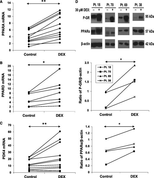 Figure 4. Effect of DEX on PPAR expression. CLL cells from the indicated patient samples were treated with or without DEX for 18 hours. (A) PPARA, (B) PPARD, and (C) PDK4 transcripts (relative to HPRT) were then measured by quantitative polymerase chain reaction. (D) Expression of phospho-GR and PPARα proteins were also measured in 4 patients by (top) immunoblotting, with β-actin used as a loading control, and (middle and bottom) quantified by densitometry. PPARα protein and mRNA were both increased by DEX at this time.