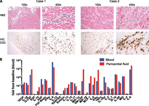 Figure 4. Analysis of cardiac-specific toxicity. (A) Pathologic and immunohistochemical analysis of myocardium from both patients. Hematoxylin and eosin (H&E) stained sections of myocardium shown at two magnifications for each patient (top panels), demonstrating lymphocytic infiltrate and diffuse myocyte necrosis. Immunohistochemical (IHC) staining with anti-CD3 (lower panels) demonstrates that lymphocytic infiltrates are T cells, shown at two magnifications. (B) Cytokines in the peripheral blood and the pericardial fluid in Case 2 obtained post mortem show evidence of T-cell activation. Thirty cytokines were assayed; each cytokine level shown is normalized to the concentration of that cytokine in a peripheral blood sample obtained at baseline. The patient was given injections of filgrastim (G-CSF) as per standard of care post-ASCT. Baseline levels of cytokines in blood were VEGF, 1.73 pg/mL; IL-1β, 0.5 pg/mL; G-CSF, 10.51 pg/mL; epidermal growth factor (EGF), 23.13 pg/mL; IL-10, 2.54 pg/mL; HGF, 357.83 pg/mL; FGF-basic, 4.45 pg/mL; IFN-α, 70.76 pg/mL; IL-6, 3.42 pg/mL; IL-12, 93.34 pg/mL; regulated upon activation, normal T-cell expressed and secreted (RANTES), 12 717 pg/mL; eotaxin, 76.1 pg/mL; IL-13, 0.53 pg/mL; IL-15, 59.94 pg/mL; IL-17, 0.16 pg/mL; macrophage inflammatory protein 1 alpha (MIP-1α/CCL3), 14.85 pg/mL; GM-CSF, 0.77 pg/mL; MIP-1β, 36.44 pg/mL; MCP-1, 953 pg/mL; IL-5, 0.34 pg/mL; IFN-γ, 2.49 pg/mL; tumor necrosis factor alpha (TNF-α), 1.26 pg/mL; IL-1Rα, 37.66 pg/mL; IL-2, 0.56 pg/mL; IL-7, 15.36 pg/mL; IP-10, 23.14 pg/mL; IL-2R, 205.81 pg/mL; MIg, 10.51 pg/mL; IL-4, 9.91 pg/mL; and IL-8, 10.68 pg/mL.