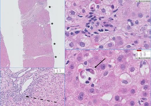 Figure 4. Liver histology of a patient with chronic HEV. The histopathology of chronic HEV infection in this patient is characterized by a dense lymphoplasmocellular infiltrate (dashed arrow) in the portal tracts, combined with severe fibrosis (F3) and portoportal septation (*). Multiple foci of apoptotic bodies are seen in the lobuli surrounded by a few inflammatory cells, indicating individual hepatocyte necrosis (councilman bodies: arrow) and probably caused by viral replication.