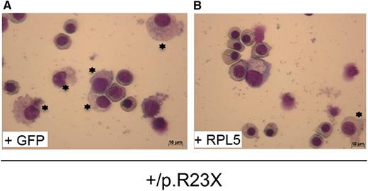 The defect in erythroid progenitors from RPL5+/R23X iPSs generated from DBA affected fibroblasts (A), where most of the cells are myeloid cells, and the rescue by the wild RPL5 transgene, where most of the cells are erythroid progenitors (B). See the complete Figure 7 in the article by Garçon et al that begins on page 912.