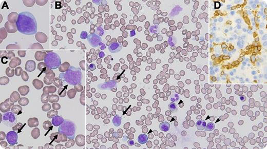 A previously healthy 23-year-old Japanese male had complained of a fever lasting a month. A physical examination revealed marked hepatosplenomegaly without significant peripheral lymphadenopathies. Routine laboratory tests showed a hemoglobin level of 9.1 g/dL, 95 × 109/L platelets, 7.1 × 109/L leukocytes, and an elevated lactate dehydrogenase level of 522 U/L (reference interval, 120-220 U/L). A peripheral blood smear showed 2.0% atypical lymphoid cells with basophilic cytoplasm and multiple nucleoli (panel A). Bone marrow aspiration revealed 23.8% atypical lymphoid cells (panels B-C, arrows). The small cells had a scant cytoplasm and condensed chromatin, whereas the large cells had a voluminous cytoplasm and moderately dispersed chromatin. The accompanying dyshematopoiesis, including the megaloblastoid changes and pseudo-Pelger-Huët anomaly, was also recognized (arrow heads). Histological sections of the bone marrow showed the dendritic distribution of CD3+/CD4−/CD5−/CD7+/CD8−/CD56−/CD57−/GranzymeB−/TIA-1+/TCRβ−/TCRγ+-lymphoid cells, suggesting their sinusoidal infiltration (panel D, stained with anti-CD3). The patient was finally diagnosed with hepatosplenic T-cell lymphoma. / Hepatosplenic T-cell lymphoma is rare and is predominantly found in young male adults. Patients usually suffer from hepatosplenomegaly but not lymphadenopathy. The bone marrow is commonly involved, and peripheral blood infiltration becomes conspicuous in the clinical course. This disease usually shows an aggressive clinical course. No standard therapeutic strategy is currently established.