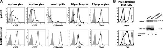 Figure 1. Expression of GPI-anchored proteins on patient's peripheral blood cells; and reduced activity of PIGT mutant in restoring surface expression of GPI-anchored proteins after transfection into PIGT-null cell lines. (A) Expression of (left) CD58 and CD59 on red cells, (center) CD24 and CD66b on neutrophil granulocytes, and (right) CD48 on B and T lymphocytes. The first row shows the expression of GPI-anchored protein (AP) at the time of ultradeep sequencing (4.5 years after start of eculizumab); the second row shows expression of GPI-AP in a healthy control. In healthy controls, CD58 and CD59 are expressed on >99.9% and >99.5% of red cells, respectively, and CD24/CD66b is expressed on >99.8% of neutrophil granulocytes (second row). In contrast, the patient shows a mosaic of cells with normal expression of GPI-anchored proteins and cells with reduced or completely missing expression of GPI-AP on (left) erythrocytes or (center) neutrophil granulocytes. The cell populations that completely lack expression of the respective GPI-AP are indicated by arrows; the populations with reduced GPI-AP expression are marked by asterisks. The patient did not receive any blood transfusions over a period of 3 months before this measurement. Expression of the GPI-AP CD48 on T lymphocytes was normal, whereas a subpopulation of B lymphocytes did not express the GPI-AP CD48. The percentages of cells with reduced or absent GPI-AP, ie, PNH cells, and normal range is shown in the supplemental Materials. (B) PIGT-deficient Chinese Hamster Ovary cells were transiently transfected with wild-type or a mutant version skipping exon 11 of transcript NM_0015937. (Left) Restoration of the cell surface protein levels of wild-type PIGT and the mutant PIGT lacking 28 amino acids encoded by exon 11 was assessed by flow cytometry. Wild-type PIGT efficiently restored expression levels of CD59 and CD55 at the cell surface (dotted black lines), whereas the mutant PIGT did not rescue CD59 and only partially rescued CD55 expression (solid black lines). Dark shading, empty vector; light shading, isotype-matched control. (Right) Expression levels of transfected wild-type and the mutant HA-tagged PIGT. PIGT proteins were determined by western blotting with anti-HA; GAPDH, loading control. Normalized PIGT levels are shown at the bottom.