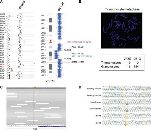 Figure 2. Ultradeep sequencing of all exons of genes involved in GPI anchor synthesis reveals two mutation events in PIGT: a germline splice site mutation and a somatic deletion. (A) DNA was isolated from whole blood and enriched for all exons of genes involved in GPI anchor synthesis and subjected to ultradeep sequencing. The coverage of PIGT exons was significantly reduced compared with exons of all other GPI anchor synthesis genes, suggesting a deletion involving PIGT. The extent of the deletion was further characterized by arrayCGH comprising in total 8 MB, arr20q11.23q13.12. (B) FISH with BAC clone RP3-337O18 (G) and a probe targeting the centromere of chromosome 20 (R) was used to analyze the deletion in T lymphocytes and granulocytes. Although 2 signals of RP3-337O18 were present in all complete metaphases of T lymphocytes, the majority of granulocytes showed only 1 signal for RP3-337O18, indicating a somatic deletion in a myeloid lineage. (C) A single nucleotide substitution in PIGT affecting the splice acceptor site of intron 10, NM_015937:c.1401-2A>G, was observed in the ultradeep sequencing data of DNA extracted from whole blood. In total, 1463 sequence reads covered the canonical splice site, and 85% of these reads showed the alternate base, indicating that the mutation is present on the undeleted haplotype of PIGT. (D) The splice site mutation was validated by ABI Sanger sequencing and shown to be heterozygous in DNA extracted from epithelial cells of a buccal swap, confirming its presence in different tissues.