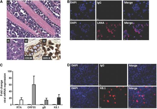 Figure 1. Characterization of UM-PEL-3 cells. (A) Pathological findings for the UM-PEL-3 xenograft mouse model. (I-II) Hematoxylin and eosin-stained tissue sections of the gastrointestinal tract showing extensive infiltration of the muscularis propria by lymphoma cells. (II) Higher magnification of pleomorphic lymphoma cells with hyperchromatic nuclei. (III) Immunohistochemistry for CD138 and (IV) HHV8 latent antigen LANA. Original magnification ×400 (I) and ×600 (II-IV). (B) IFA of UM-PEL-3 cells reveals positive staining for HHV8 latent antigen LANA (red). (C) UM-PEL-3 cells were stimulated with 1 mM butyrate for 4 days and RNA expression of the indicated transcripts was measured by qRT-PCR. Fold change compared with unstimulated cells indicates induction of IE (RTA), early (ORF55), or late (gB and K8.1) lytic genes. Error bars correspond to standard error of mean. (D) Immunostaining image of late lytic protein K8.1 (red) in UM-PEL-3 cells stimulated with 0.75 µM SAHA for 24 hours (bottom) and unstimulated cells (top). For panels B and D, nuclei are stained with 4,6 diamidino-2-phenylindole (DAPI; blue). Magnification ×400. Experiments depicted in panels B-D were repeated thrice independently in triplicate. The representative data from one experiment are shown.
