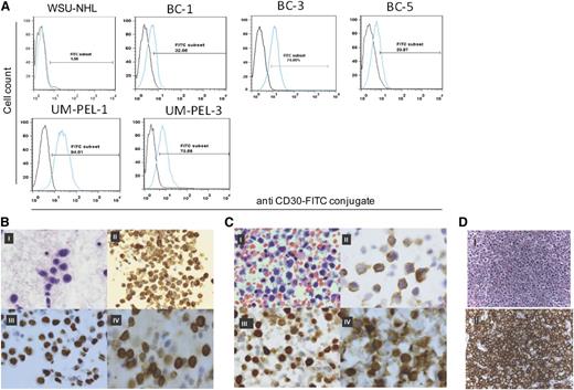 Figure 2. CD30 expression in PEL cell lines and primary tumors. (A) Histogram of flow cytometric analysis shows CD30 staining on the indicated PEL cell lines and control WSU-NHL cell line. Data were obtained by acquiring 1 × 104 cells stained with the anti-CD30-fluorescein isothiocyanate (FITC) antibody. Blue line indicates CD30-stained cell population and black line indicates background fluorescence observed with isotype control. (B-D) CD30 expression in primary PEL cells. Malignant cells from PEL patient (case 1) are highlighted with Papanicolaou stain (I). Immunocytochemistry analysis shows positive staining for epithelial membrane antigen (EMA) (II), HHV-8 latent antigen LANA (nuclear stain) (III), and CD30 (IV). Original magnification: I, III, IV ×100 and II ×50. (C) Large and discohesive malignant cells from PEL patient (case 2) are highlighted with hematoxylin and eosin stain (I). Immunocytochemistry analysis shows positive staining for EMA (II), HHV-8 latent antigen LANA (nuclear stain) (III), and CD30 (IV). Original magnification: I-IV ×100. (D) Top shows hematoxylin and eosin staining of PEL patient (case 3) lymphoma cells and bottom shows an immunohistochemistry stain for CD30 in neoplastic cells of the same PEL patient. Original magnification ×600.