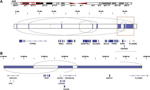 Figure 4. A likely chromothripsis event resulting in loss of the CDKN2A/B locus. Shown are regions of somatic copy number loss (blue) detected by HMMCopy analysis of a single case. Gray arcs represent rearrangement breakpoints and connections, as determined by contigs resulting from whole genome assembly of that case. (A) The rearranged region includes a series of deleted segments and encompasses many genes. The coordinated loss of genetic material and focused rejoining of fragments in these discrete regions is indicative of a single mutational event followed by DNA repair in a single cell cycle and is consistent with the chromothripsis model.32 (B) An expanded view of the boxed region from (A) is shown. One of the deleted segments encompasses both CDKN2A and CDKN2B, known to be targets of focal deletion in DLBCL6 and also found to be commonly deleted in this cohort.
