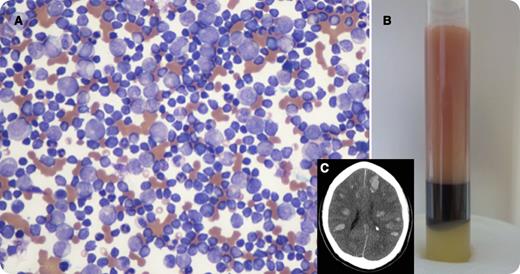 A 56-year-old male with no known past medical history presented with right-sided weakness, altered mental status, and acute respiratory failure. On presentation, his white blood cell count was 662 000/mm3, hemoglobin was 6.4 g/dL, and platelets were 20 000/mm3, with ∼80% blasts. Panel A is a blood smear obtained on presentation and panel B is the patient’s peripheral blood in a tube demonstrating his markedly elevated leukocrit relative to his hematocrit. Following intubation, emergent leukapheresis was performed, which resulted in a >50% reduction of his white blood cell count. His mental status continued to deteriorate with the absence of brain stem reflexes. A CT scan of the head was performed (panel C), which revealed numerous bilateral intracranial hemorrhages. The patient died shortly after admission secondary to massive cerebral bleed. Peripheral blood flow cytometry confirmed the diagnosis of an acute precursor B-lymphoblastic leukemia with >95% of cells positive for CD10, CD19, CD34, CD38, and HLA-DR. The interphase fluorescence in situ hybridization was positive for t(9;22)/BCR-ABL1 in >90% of the cells.