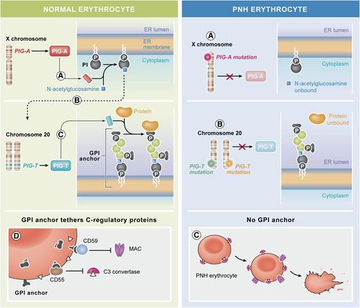 PNH arises through a block in the biosynthesis of the GPI anchor. (Left) Normal erythrocytes and the biosynthesis of GPI. (A) With phosphatidylinositol (PI) on the cytoplasmic side of the ER, the first biosynthetic step, the addition of N-acetylglucosamine to PI is catalyzed by an enzyme complex that comprises a subunit encoded by the X-linked gene PIG-A. (B-C) The biosynthetic pathway proceeds through several enzymatic steps (broken arrow) that add further sugar moieties (green symbols), until the complete GPI molecule is on the luminal side of the ER. Preformed protein (ochre) becomes covalently linked to the GPI anchor through a transamidation reaction. This step is catalyzed by an enzyme complex that comprises a subunit encoded by the gene PIG-T on chromosome 20. (D) Among the red cell proteins that are tethered to the membrane through GPI anchors, ≥2 are important in protecting red cells from activated complement: CD55 that regulates the C3 convertase and CD59 that impedes the lytic action of the membrane attack complex (MAC). (Right) Abnormal PNH erythrocytes: the tethering to the membrane of proteins that need the GPI anchor can be compromised by failure of any of the enzyme reactions above. (A) In the majority of patients with PNH, a somatically acquired inactivating mutation11 of PIG-A (of which in each cell there is only 1 active allele on the X-chromosome) blocks the very take-off of the GPI biosynthesis. (B) Krawitz et al report for the first time a patient in whom the block is instead at the very last step: the GPI anchor is ready, but the protein does not become linked to it because of mutations in both alleles of the PIG-T gene. (C) PNH erythrocytes, lacking CD55, bind C3 convertase; moreover, because they lack CD59, they are vulnerable to MAC attack, and when this takes place, they are lysed. The elements of this figure pertaining to the GPI biosynthetic pathway (top two and middle two panels) were redrawn from the work of Kinoshita et al.,12 and the elements pertaining to the action of complement on normal and on PNH red cells (bottom two panels) were redrawn from Luzzatto et al.13 Professional illustration by Xavier Studio.