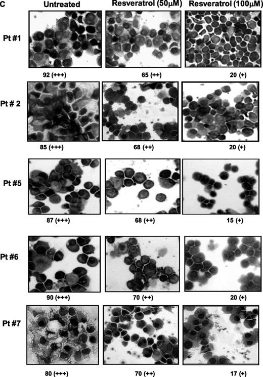 Figure 7. Resveratrol inhibits the proliferation of CD138+ cells from patients with MM and down-regulates NF-κB and STAT3 activation. (A) Enriched CD138+cells (2 × 105 /0.1 mL) from bone marrow aspirates of patients with multiple myeloma were cultured in the absence or presence of indicated concentrations of resveratrol for 24 hours, and cell proliferation was measured by MTT assay as described in “Materials and methods.” Values represent the mean ± SD of triplicate cultures. *P < .05. (B) Enriched CD138+ cells (2 × 106 cells) from bone marrow aspirates of patients with MM as indicated were cultured in the absence or presence of resveratrol (50 μM) for 12 hours and then tested for NF-κB activity in the nuclei by electrophoretic mobility shift assay as described in “Materials and methods.” (C) STAT3 activation status was determined by fixing the untreated and 12-hour resveratrol-treated (50 μM, 100 μM) enriched CD138+ cells (2 × 106 cells) on slides by cytospin followed by immunocytochemistry for STAT3 as described in “Materials and methods.” Patients’ numbers are indicated beside each panel. Original magnification × 200. One hundred cells were counted for each patient. Grading was as follows: + indicates less than10% cells with nuclear positivity; ++, 10% to 50% cells with nuclear positivity; +++, greater than 51% cells with nuclear positivity. The ++ and + indicate significantly different nuclear (P < .05) positivity than untreated cells. (D) CD138+ cells (2 × 104 cells) from patients no. 8 and no. 9 were treated with 25 μM resveratrol, 20 nM bortezomib, 10 μg/mL thalidomide either alone or in combination for 24 hours at 37°C. Cells were incubated with anti-annexin V antibody conjugated with FITC and then analyzed by a flow cytometer for early apoptotic effects.