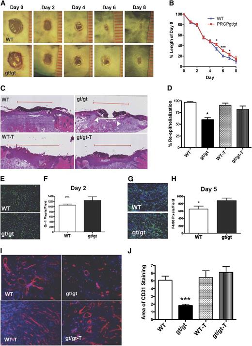 Figure 3. Influence of PRCP on skin wound healing. (A) Full-thickness wounds from WT and PRCPgt/gt mice were imaged at D0, D2, D4, D6, and D8. Each unit on the ruler equals 1 mm in length. External wound images were obtained using a Nikon SMZ-U dissecting microscope (original magnification ×1). (B) Wound lengths are expressed relative to D0 length (n = 10 in both groups). On 2-way analysis of variance, the PRCPgt/gt wounds closed significantly slower (P < .047). (C) Hematoxylin and eosin–stained slides from D5 wounds of WT and PRCPgt/gt (gt/gt) mice that were untreated or treated with ramipril (T) were analyzed for their extent of reepithelialization. The red line demarcates the total length of the original wound; the white line represents the “wound gap.” The white arrows indicate the end of the epithelial tongues of a closing wound. In photographs in which no white line is seen, the wound gap is 0 and the wound has completely reepithelialized. (D) The percent reepithelialization is shown for WT (n = 21), gt/gt (n = 6), WT-T (n = 16), and gt/gt-T (n = 13) mice. (E) Frozen sections of D2 wounds were stained with anti–Gr-1 to assess neutrophil infiltration. (F) Mean number of neutrophils as pixels/HPF, 20× on microscopy (n = 6 in both groups). (G) Frozen sections from D5 skin wounds were stained for F4/80 to assess macrophage infiltration. (H) Mean number of macrophages as pixels/HPF on microscopy (n > 8 in both groups). (I) CD31 staining on frozen sections from D5 wounds in WT, gt/gt, WT-T, and gt/gt-T were obtained. (J) The area of CD31 staining in the 4 groups of animals was compared by morphometric analysis using the National Institutes of Health’s ImageJ software (n ≥ 5 in all groups). Fluorescent wound images were obtained using a Nikon TE200 microscope with a 20×/0.45 for Matrigel plug images. The following in the figure indicate group paired Student t-test P values: *P < .05, ***P < .001.